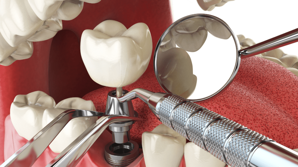 Dental implantation procedure