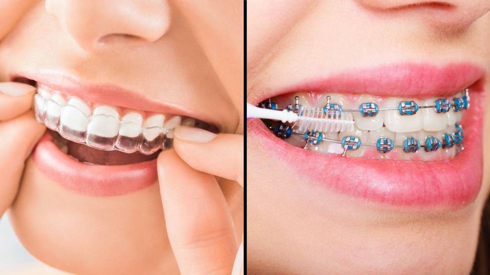 Invisalign and braces side by side