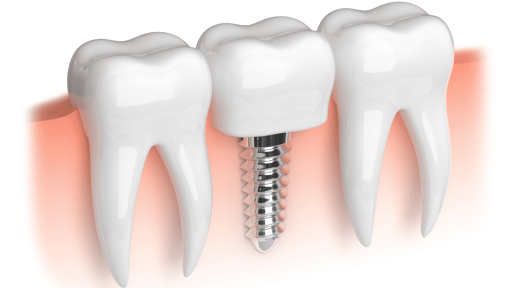 Model of white teeth and dental implant