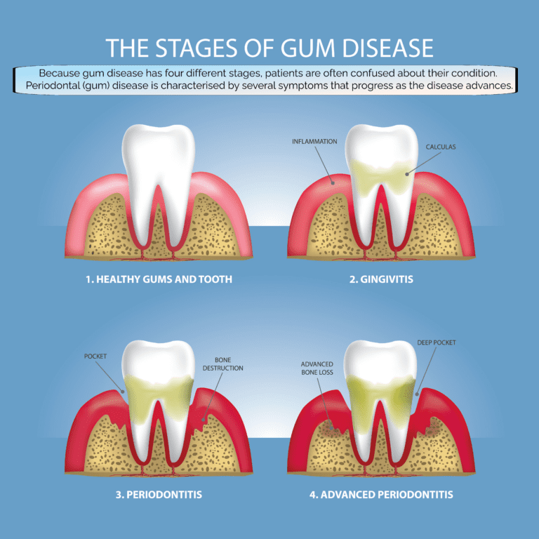 Diagram showing the four Stages of Gum Disease